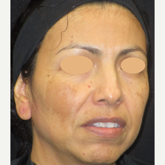 45-54 year old woman treated with Age Spots Treatment before 3152761