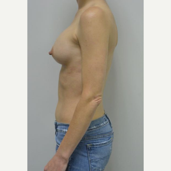 45-54 year old woman treated with Breast Implants who wants a natural look after 3604029