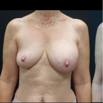 35-44 year old woman treated with Breast Lift with Implants before 3731594