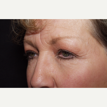 55-64 year old woman treated with Brow Lift before 3481341