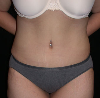 Tummy Tuck after 275742