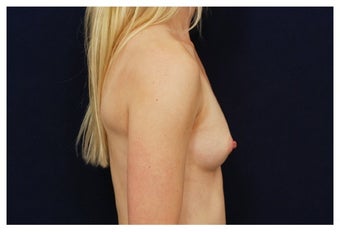 Breast Augmentation before 1206554