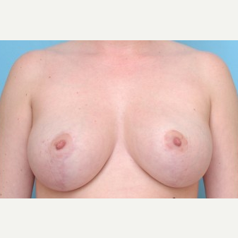 18-24 year old woman treated with Breast Reduction after 3488205