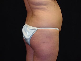 Brazilian Buttocks Lift before 145532