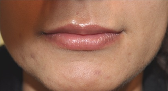 Beautiful Lips with soft Silicone implants after 1053016