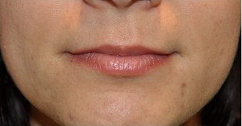 Beautiful Lips with soft Silicone implants before 1053016