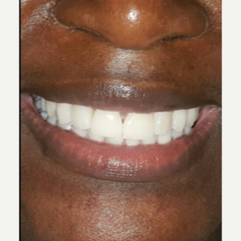 45-54 year old woman treated with Porcelain Veneers after 3176898