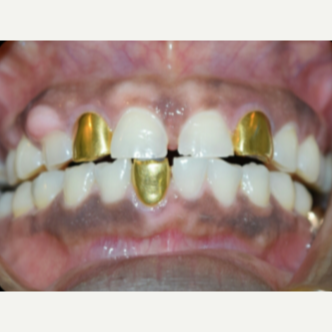 45-54 year old woman treated with Porcelain Veneers before 3176898