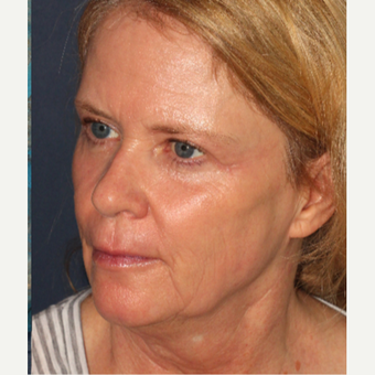 45-54 year old woman treated with Belotero after 3230331