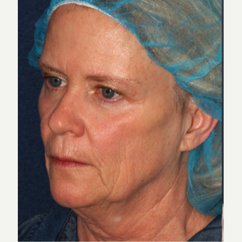 45-54 year old woman treated with Belotero before 3230331