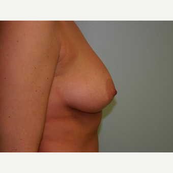 Breast Augmentation before 3560719
