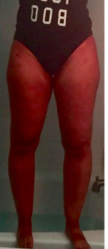 35-44 year old woman treated with Tumescent Liposuction after 2281673