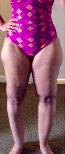35-44 year old woman treated with Tumescent Liposuction before 2281673