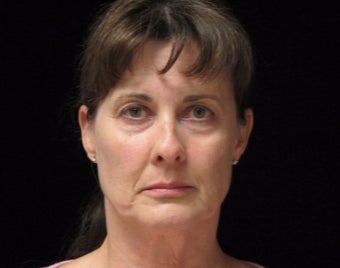 45-54 year old woman treated with Facelift before 2509162
