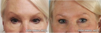Reversing "Surprised" Eyebrow look by Lowering Eyebrows with BOTOX before 1414196