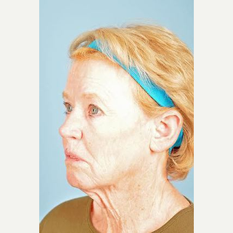 70 year old woman treated with Facelift before 3839609