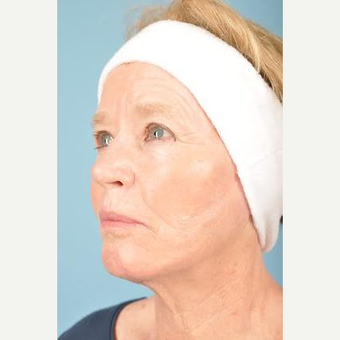 70 year old woman treated with Facelift after 3839609