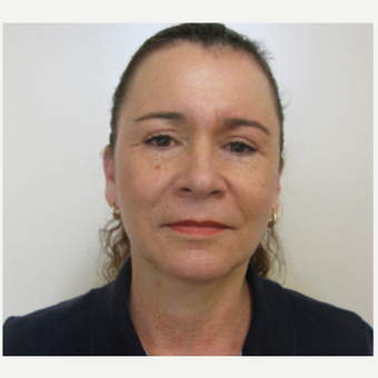 45-54 year old woman treated with Eyelid Surgery after 3440010
