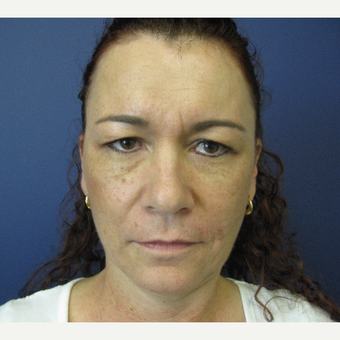 45-54 year old woman treated with Eyelid Surgery before 3440010