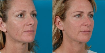 39-year-old woman treated with Facial Fat Transfer. after 574292