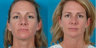 39-year-old woman treated with Facial Fat Transfer. before 574292