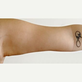 18-24 year old woman treated with Venus Freeze before 3254182
