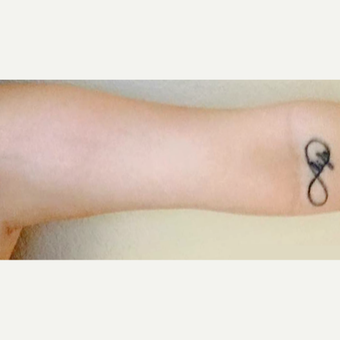 18-24 year old woman treated with Venus Freeze after 3254182