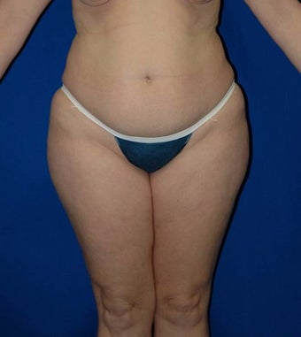 35-44 year old woman treated with SAFELipo before 3126037