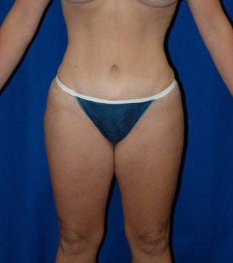 35-44 year old woman treated with SAFELipo after 3126037
