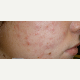 Treating acne involves the correct use of cleansers, active ingredients, and many other factors. before 3685508