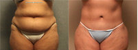 Lower Body Lift (Belt Lipectomy) before 99283