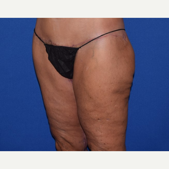 45-54 year old woman treated with Thigh Lift after 3755279