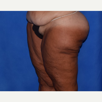 45-54 year old woman treated with Thigh Lift before 3755279