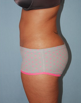 Smart Lipo after 1409634