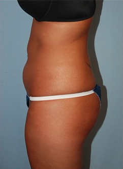 Smart Lipo before 1409634