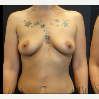 25-34 year old woman treated with Breast Augmentation before 3787579