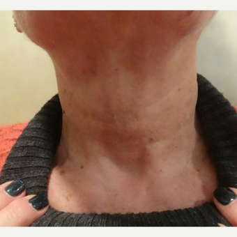 55-64 year old woman treated with Belotero after 3744571