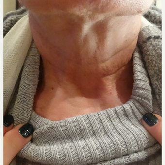 55-64 year old woman treated with Belotero before 3744571