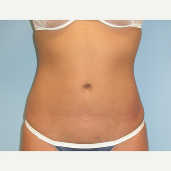 18-24 year old woman treated with Liposuction after 3086936