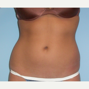 18-24 year old woman treated with Liposuction before 3086936