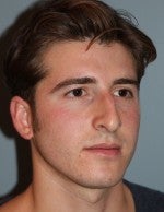 25-34 year old man treated with Rhinoplasty before 3103985