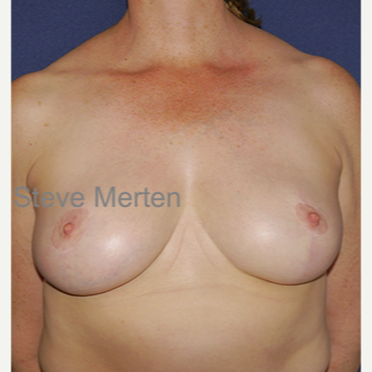 35-44 year old woman treated with Breast Reduction after 3472431