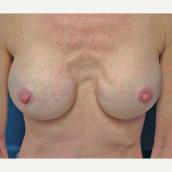 Saline implants exchanged for larger silicone implants and reduction of gap between pectoral pockets before 3205620