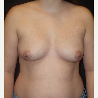 18-24 year old woman treated with Breast Augmentation before 3458257