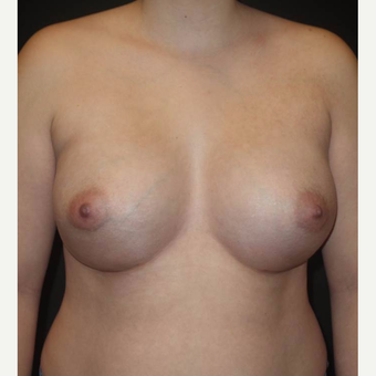 18-24 year old woman treated with Breast Augmentation after 3458257