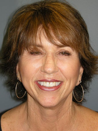 Blue Peel, Chemical Peel after 954429
