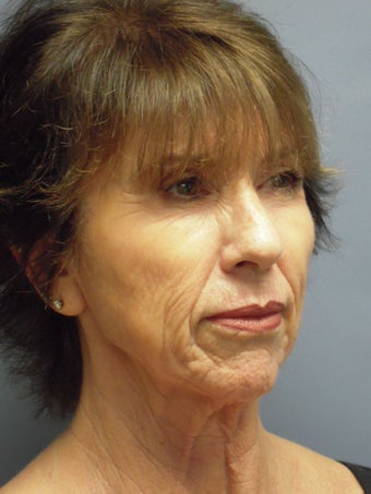 Blue Peel, Chemical Peel 954429