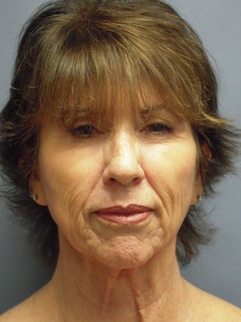 Blue Peel, Chemical Peel before 954429