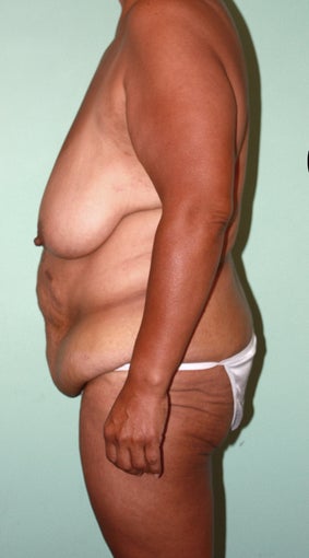 Lower Body Lift: Breast Lift, Crecent Lift, Extended Abdominoplasty before 1000285