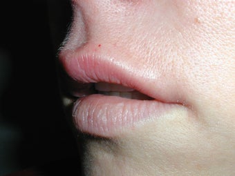 Restylane for upper lip after 100943